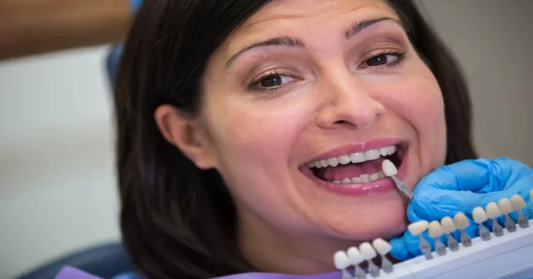 Veneers Cost